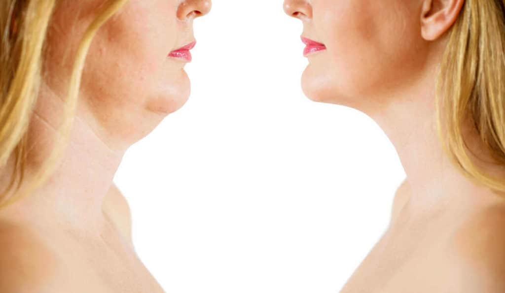 Double Chin treatment Brierley Hill before and after results