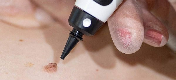 After Skin Tag Removal Brierley Hill