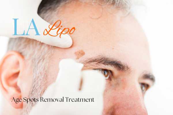 What Are the Most Effective Treatments for Age Spots Brierley Hill?