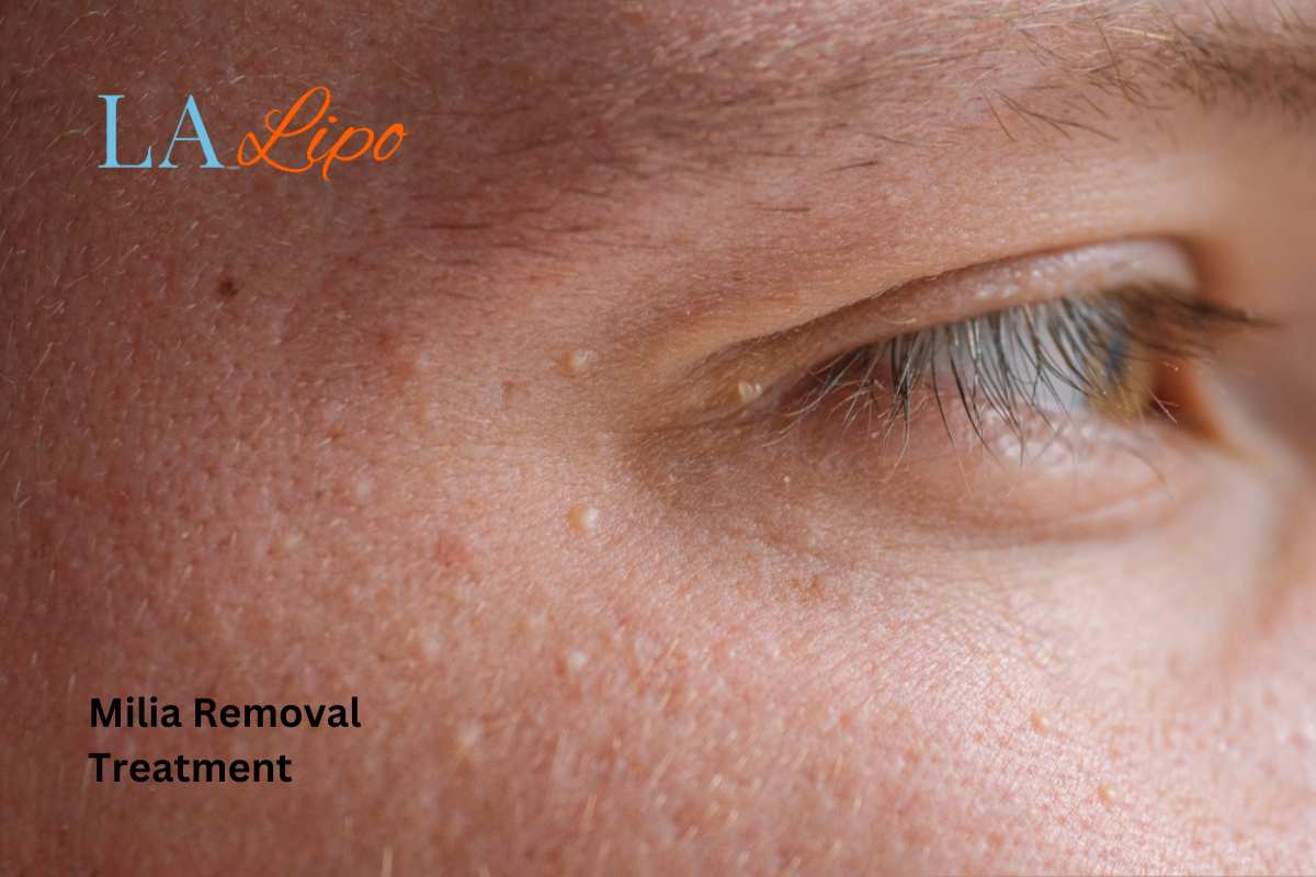 Cryopen Milia Removal: Is It the Easiest and Safest Option Brierley Hill?