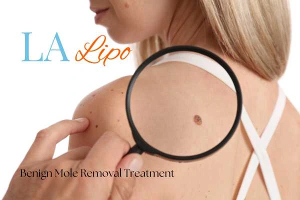 Woman having her inspection of blemish before mole removal Brierley Hill