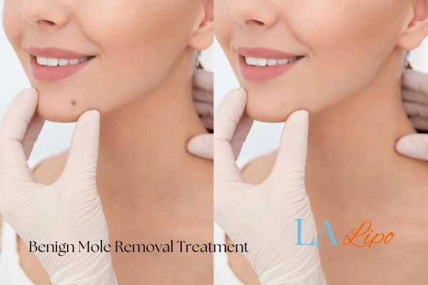Before and after mole removal Brierley Hill treatment