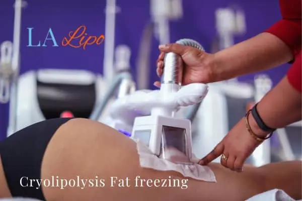 women getting fat freezing Brierley Hill