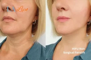 hi-fu for wrinkles Brierley Hill before and after results