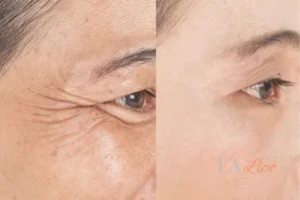 Before and after results of woman - HI-fu wrinkles reduction treatment Brierley Hill