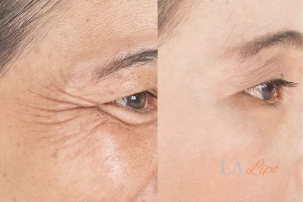 Before and after results of woman - HI-fu wrinkles reduction treatment Brierley Hill