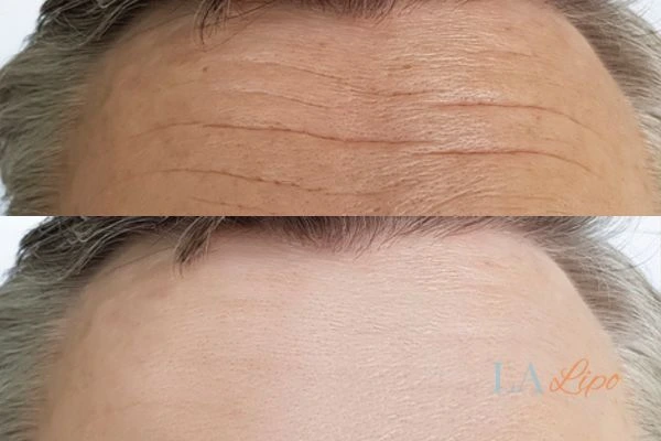results of HIFU Brierley Hill on mans forehead to help reduce lines and wrinkles