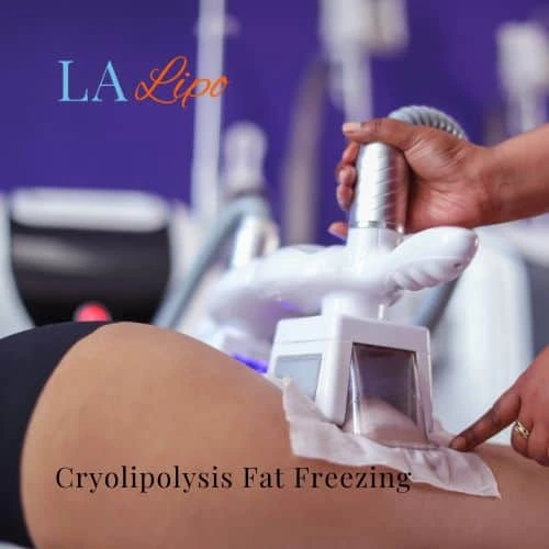 fat freezing - Cryolipolysis Brierley Hill