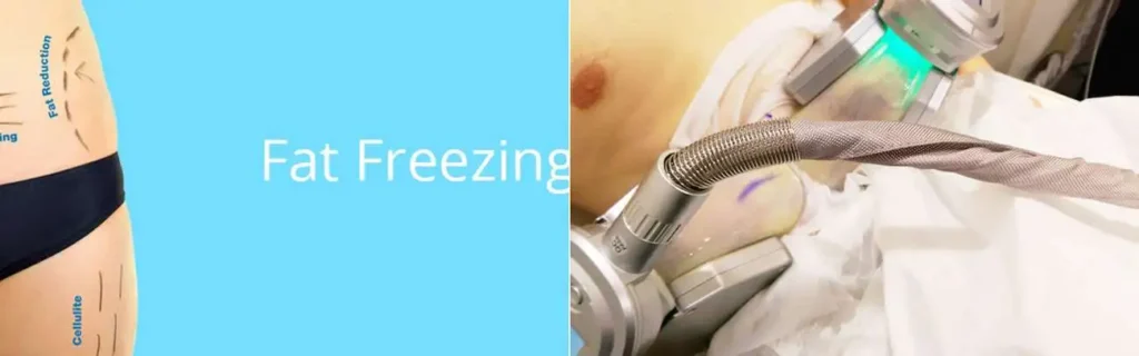 multi areas of a persons body having coolsculpting Brierley Hill treatment