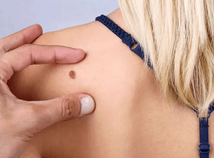 woman having mole removal Brierley Hill consultation before treatment.