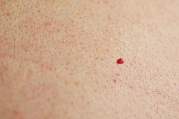 close up of a cherry angioma Brierley Hill