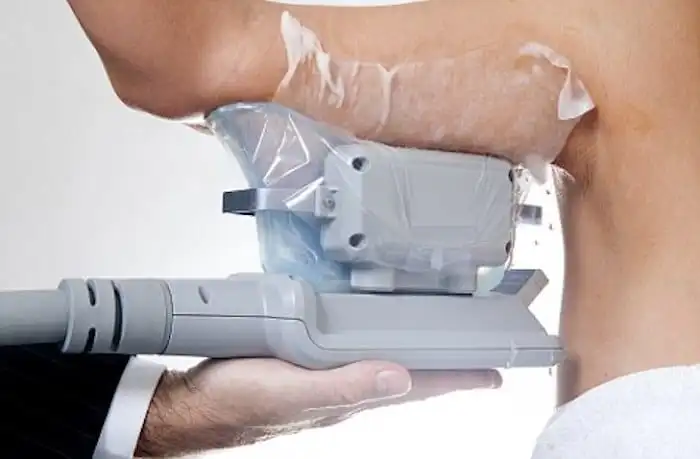 Picture of fat freezing Brierley Hill on the upper arms.