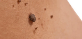 image of a skin tag Brierley Hill