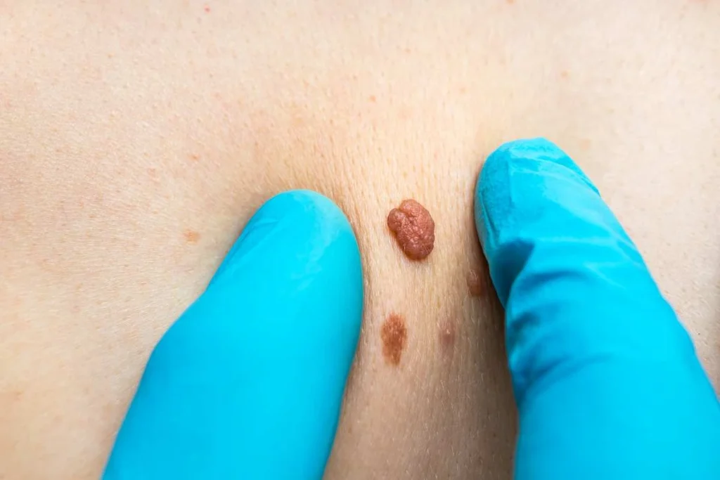 Consultant examining a skin tag Brierley Hill