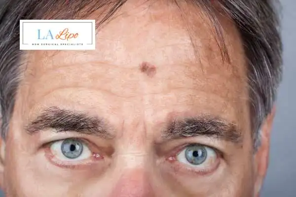 Solar Lentigo Removal Brierley Hill image of man with mark on his forehead