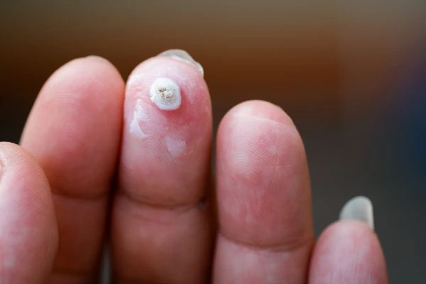 wart on person finger - cryotherapy to treat from LA LIPO Brierley Hill