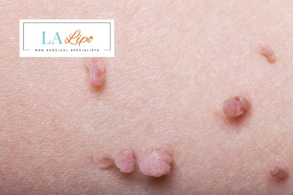 Does cryopen skin tag removal Brierley Hill hurt? Find out now call our team today!