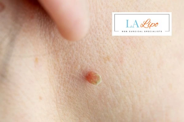 Book skin tag removal Brierley Hill today speak to our team now!
