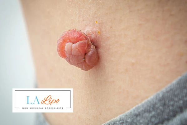 Interested in skin tag removal Brierley Hill? Concerned about the pain? Find out more today!