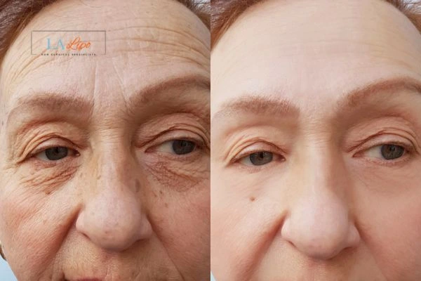 The powerful benefits of Morpheus8 Treatment Brierley Hill - Call Our team today!