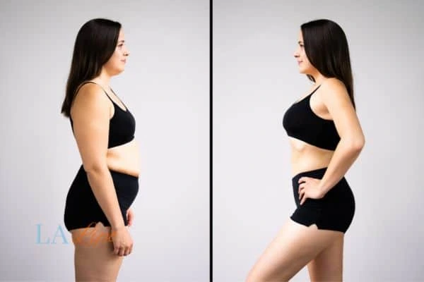 Picture of womans before and after using LA-EMS body sculpting to improve her core strength Brierley Hill