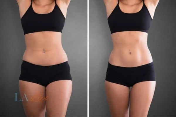 before and after results of non-surgical treatment to help a woman's body image and mental health Brierley Hill