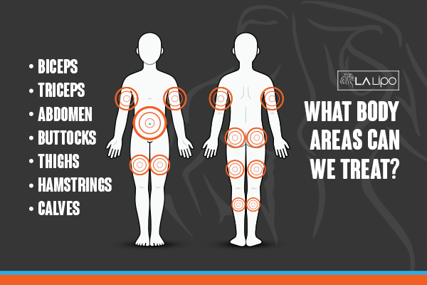 Diagram to show areas you can have LA-EMS Body Sculpting Treatment Brierley Hill