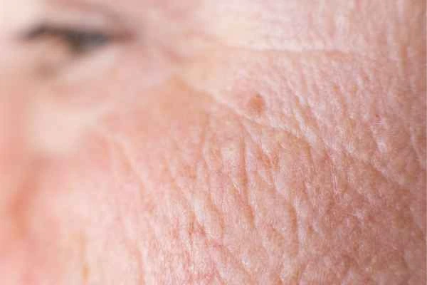 close up picture of a woman's face showing an age spot Brierley Hill