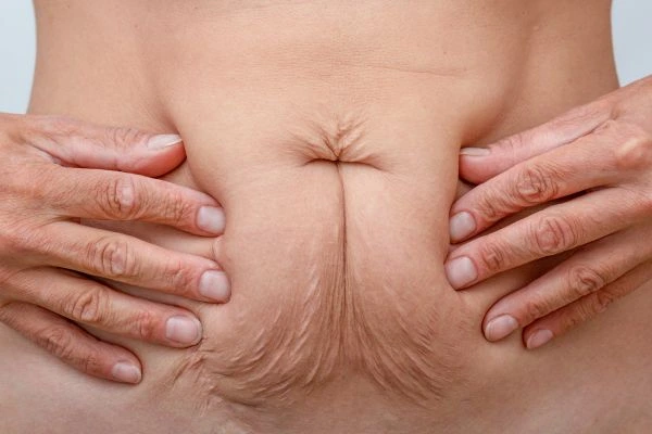 Image of a woman's stomach with loose skin - example of skin tightening Brierley Hill options