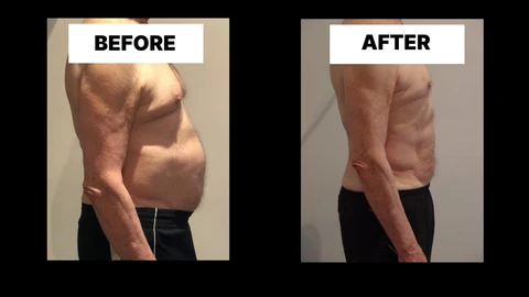 What Symptoms Can Diastasis Recti Cause in Men? Weak Core, Back Pain and Poor Posture Brierley Hill